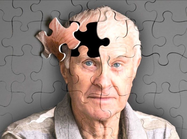 Az Alzheimer-kór korai tünetei.